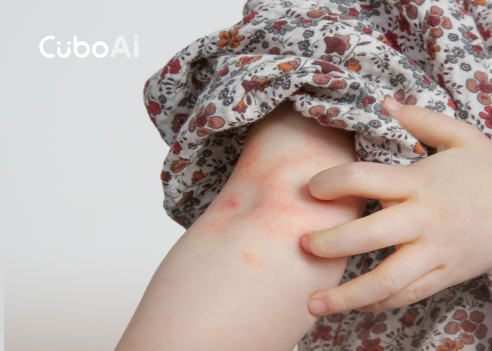 アトピー性皮膚炎から赤ちゃんを守る方法